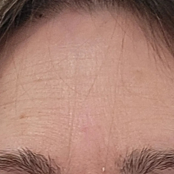 Frown lines - Before