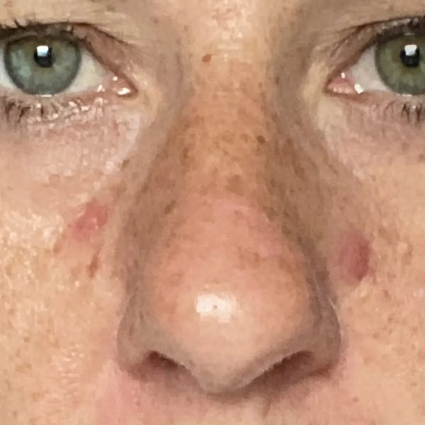 More even tone - Before