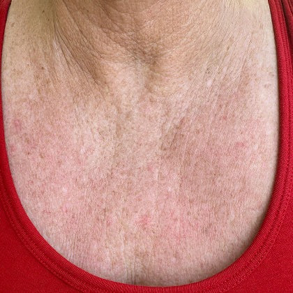 Smoother skin - Before