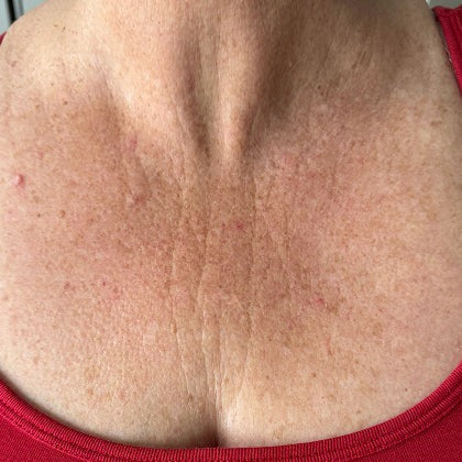 Smoother skin - After